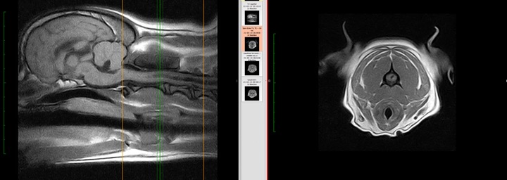 Paul Mandigers | Chiari-Malformatie en Syringomyelie